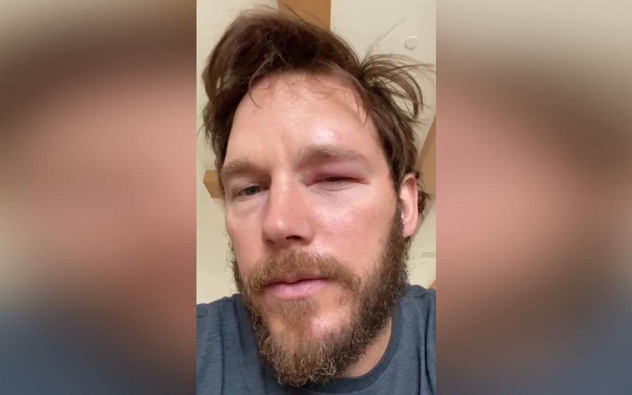 Chris Pratt Shows His Swollen Eye After Getting Stung By Bee