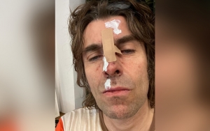 Liam Gallagher Left With Bloody Face After Falling From Helicopter