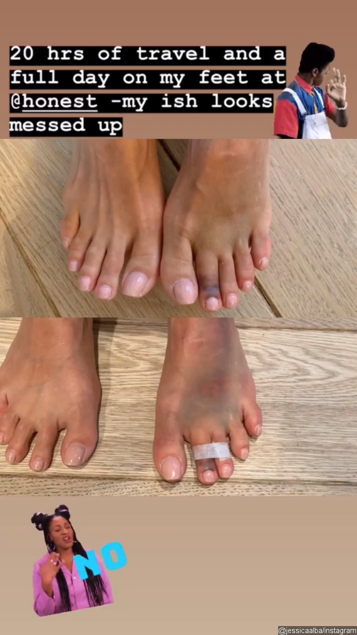 Jessica Alba Shows Off Her Broken Toe