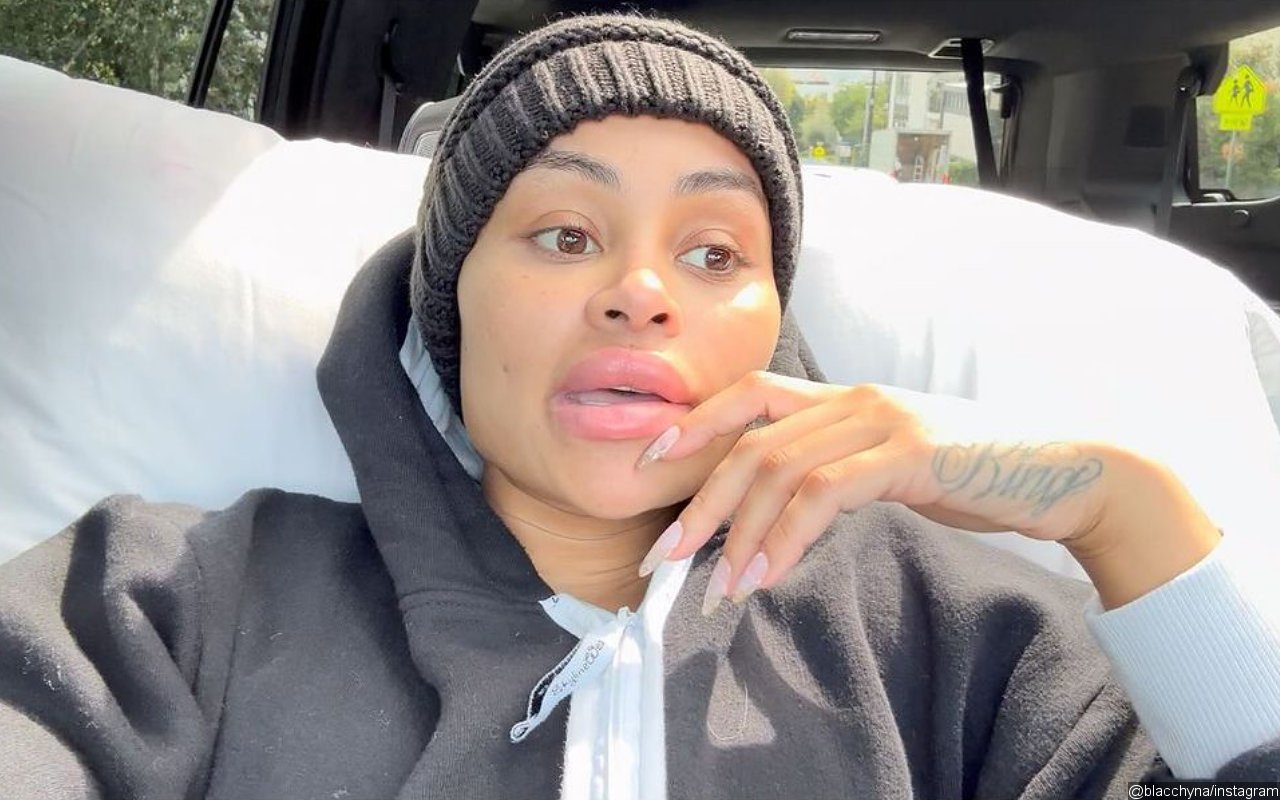 Blac Chyna Happy After Removing All Of Her Face Fillers