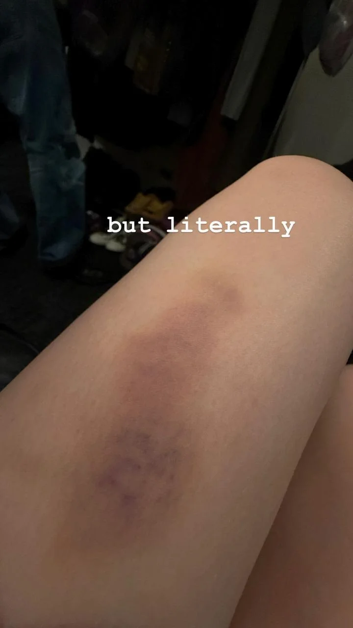 Billie Eilish shows off bruises from onstage fall