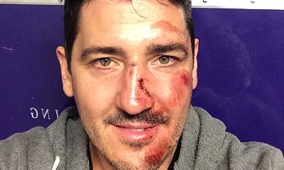 NKOTB's Jonathan Knight Misses Show After Breaking Nose in Tour Bus Accident
