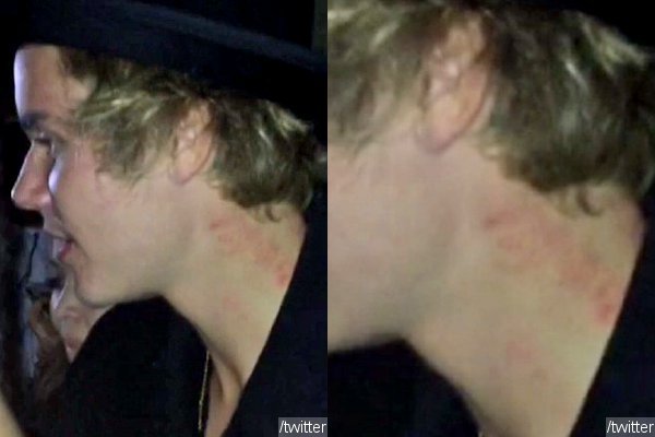 Justin Bieber Sporting Love Bites on His Neck